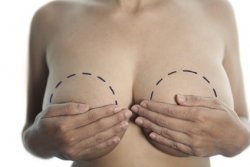Имплантация груди